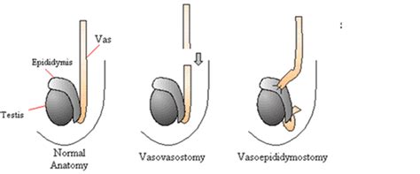 Vasectomy reversal .